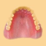 レジン床義歯　イメージ画像