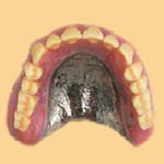 チタン床義歯　イメージ画像
