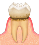 歯肉炎 イメージ画像