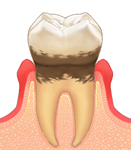 軽度歯周炎 イメージ画像