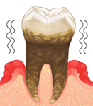 重度歯周病 イメージ画像