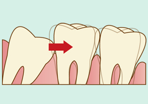 抜歯が推奨される親知らずの症状　イメージ画像